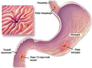 Как выглядит язва желудка