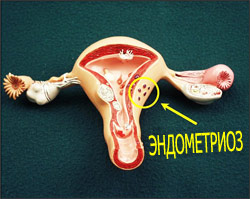 что такое эндометриоз